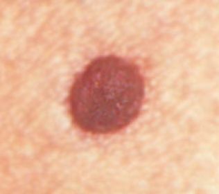 purple spots on arms? - Lupus - HealingWell.com Forum