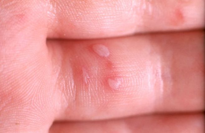 Red or black spots on fingernails – WebMD